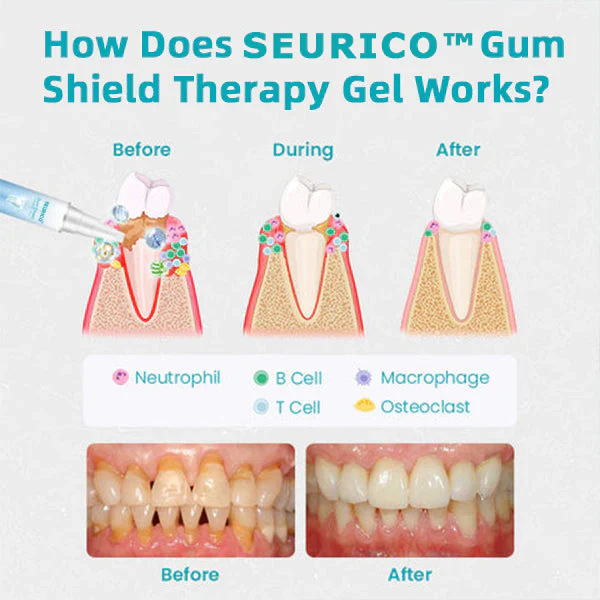 🔥Last Day 69% OFF-SEURICO™ Gum Shield Therapy Gel - Image 6